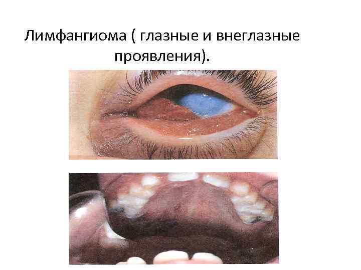 Лимфангиома ( глазные и внеглазные проявления). 