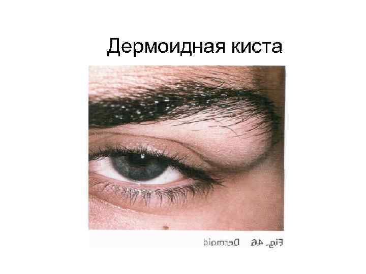 Дермоидная киста 