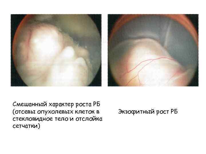 Смешанный характер роста РБ (отсевы опухолевых клеток в стекловидное тело и отслойка сетчатки) Экзофитный