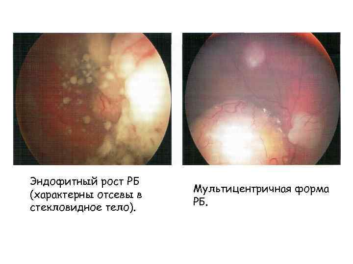 Эндофитный рост РБ (характерны отсевы в стекловидное тело). Мультицентричная форма РБ. 