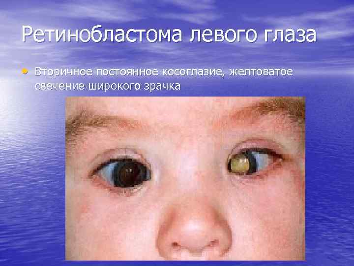 Ретинобластома левого глаза • Вторичное постоянное косоглазие, желтоватое свечение широкого зрачка 