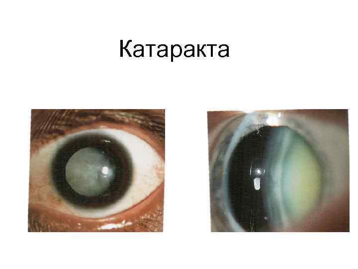 Катаракта 