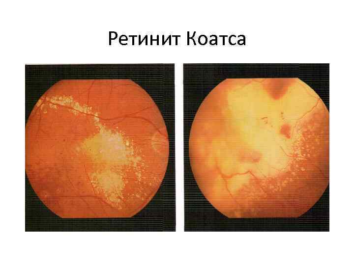 Ретинит Коатса 
