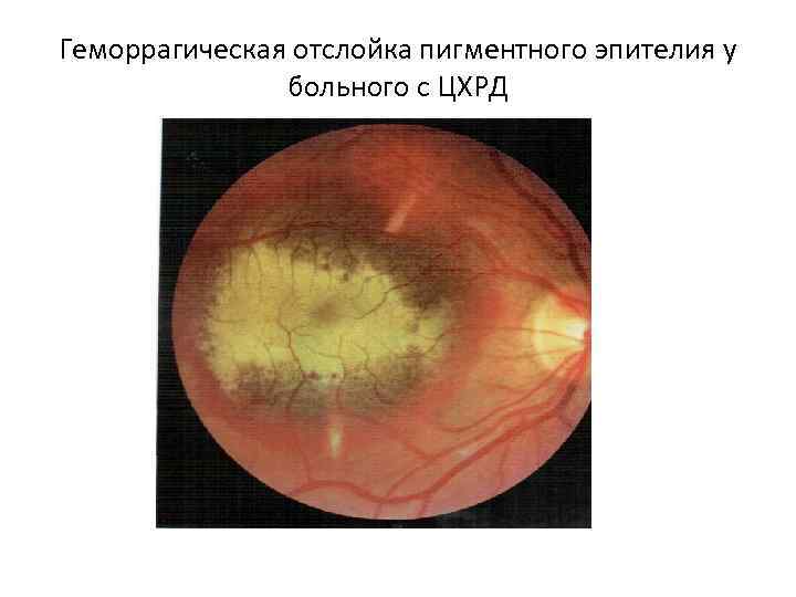 Геморрагическая отслойка пигментного эпителия у больного с ЦХРД 