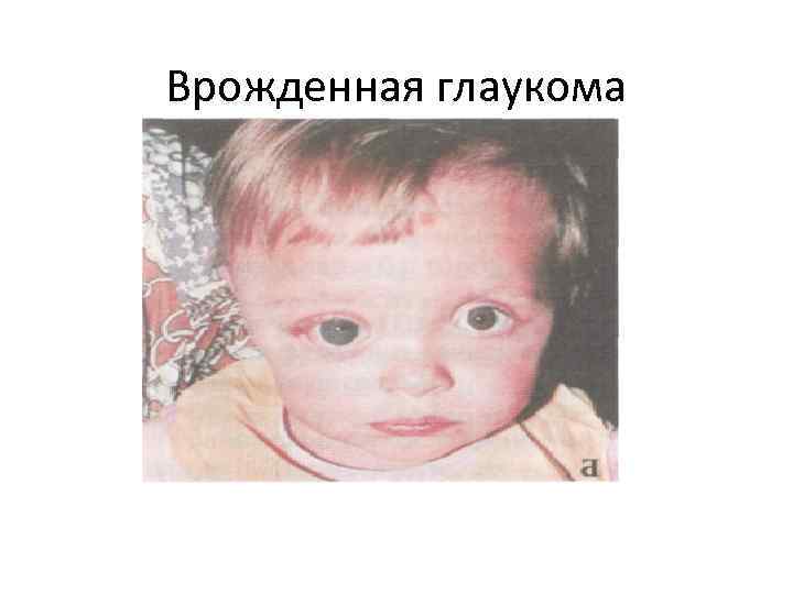 Врожденная глаукома 
