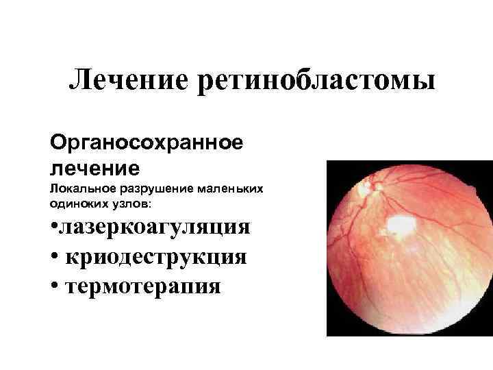 Лечение ретинобластомы Органосохранное лечение Локальное разрушение маленьких одиноких узлов: • лазеркоагуляция • криодеструкция •