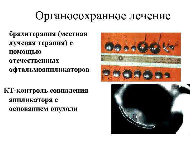 Органосохранное лечение брахитерапия (местная лучевая терапия) с помощью отечественных офтальмоаппликаторов КТ-контроль совпадения аппликатора с