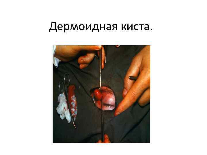Дермоидная киста. 