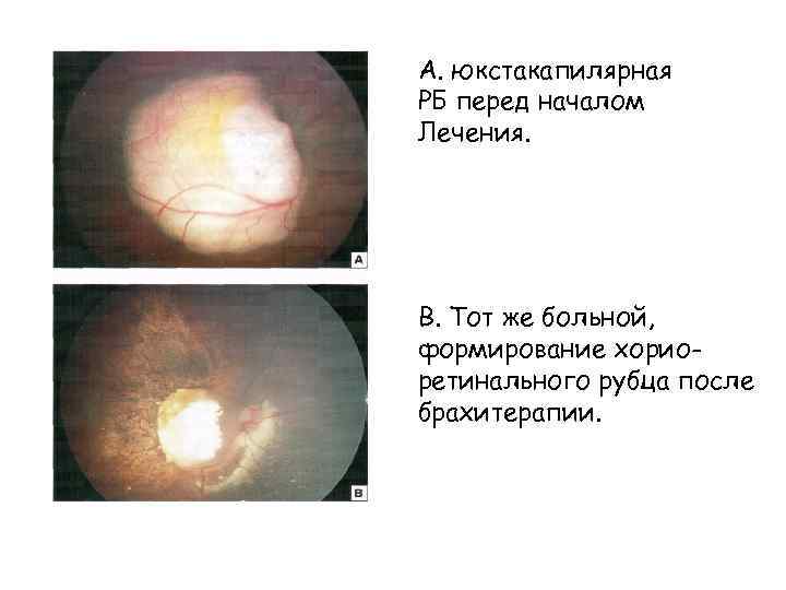 А. юкстакапилярная РБ перед началом Лечения. В. Тот же больной, формирование хориоретинального рубца после