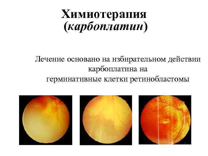 Химиотерапия (карбоплатин) Лечение основано на избирательном действии карбоплатина на герминативные клетки ретинобластомы 