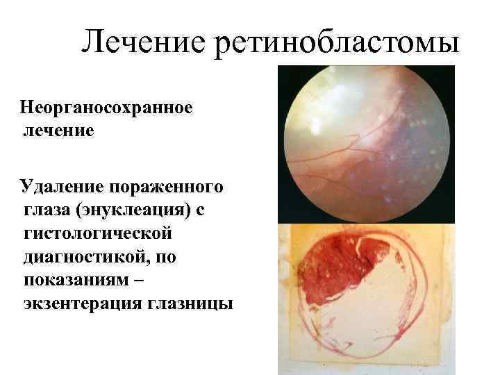 Лечение ретинобластомы Неорганосохранное лечение Удаление пораженного глаза (энуклеация) с гистологической диагностикой, по показаниям –