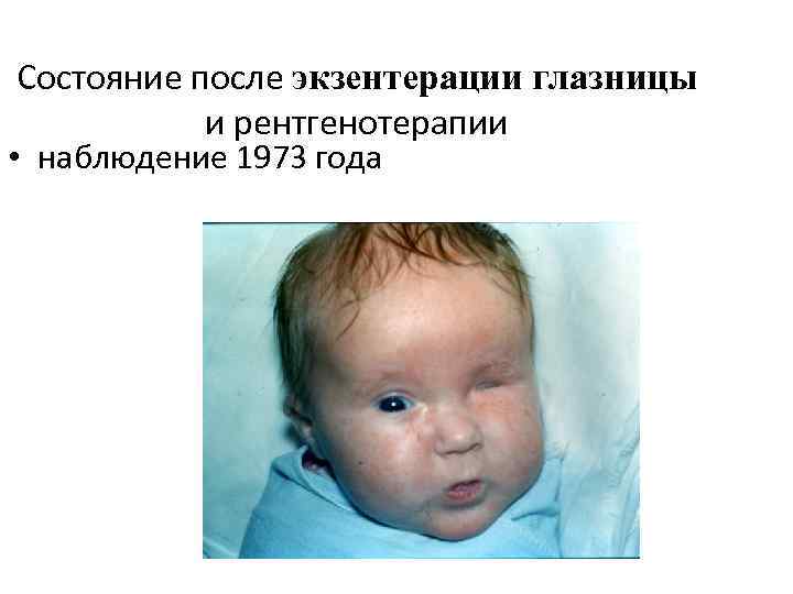 Состояние после экзентерации глазницы и рентгенотерапии • наблюдение 1973 года 