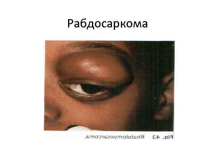 Рабдосаркома 