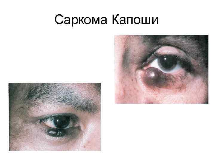 Саркома Капоши 