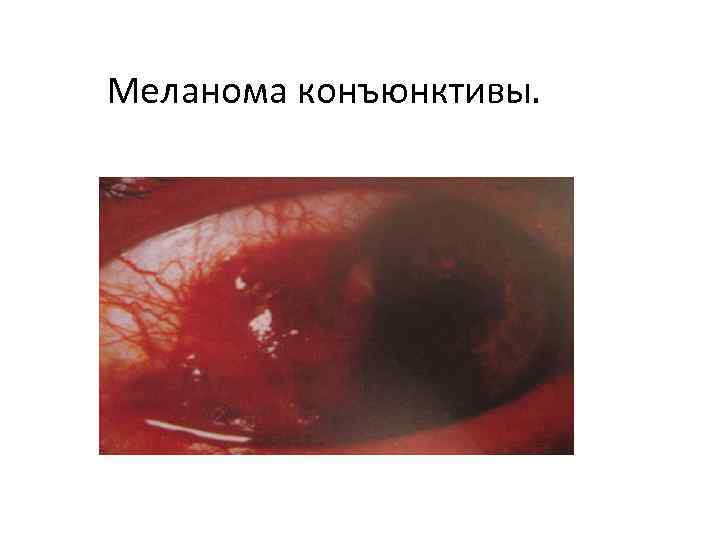 Меланома конъюнктивы. 