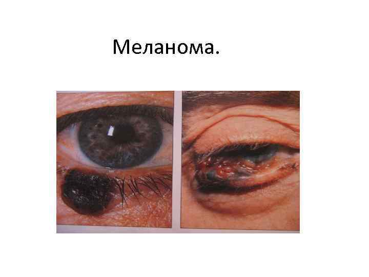 Меланома. 