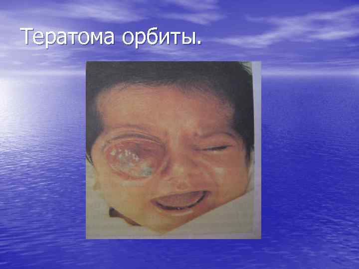Тератома орбиты. 