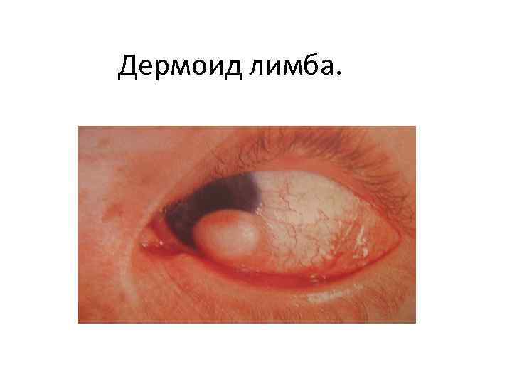 Дермоид лимба. 