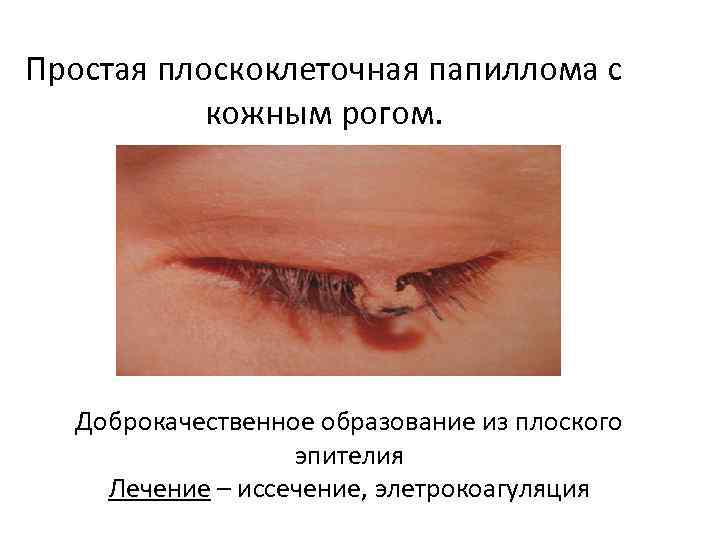Простая плоскоклеточная папиллома с кожным рогом. Доброкачественное образование из плоского эпителия Лечение – иссечение,
