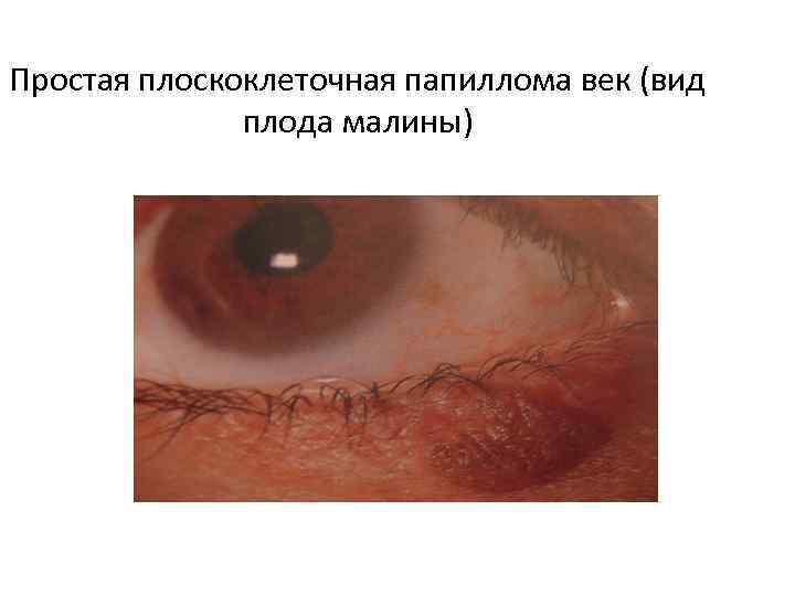 Простая плоскоклеточная папиллома век (вид плода малины) 
