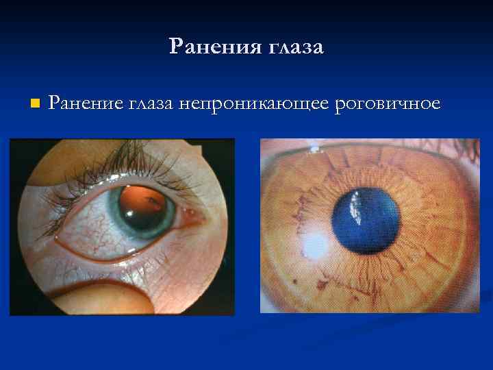 Ранения глаза n Ранение глаза непроникающее роговичное 