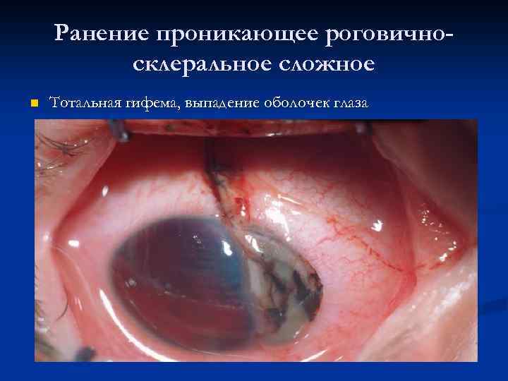 Ранение проникающее роговичносклеральное сложное n Тотальная гифема, выпадение оболочек глаза 