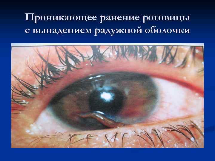 Проникающее ранение роговицы с выпадением радужной оболочки 