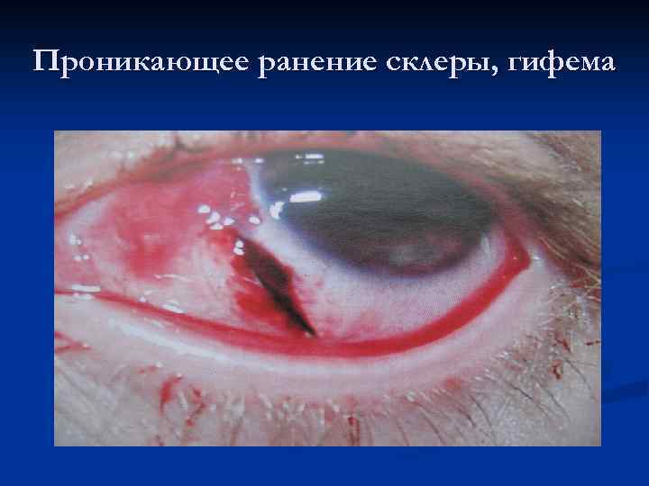 Проникающее ранение склеры, гифема 