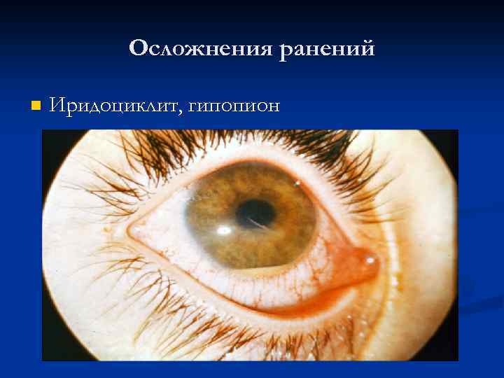 Осложнения ранений n Иридоциклит, гипопион 