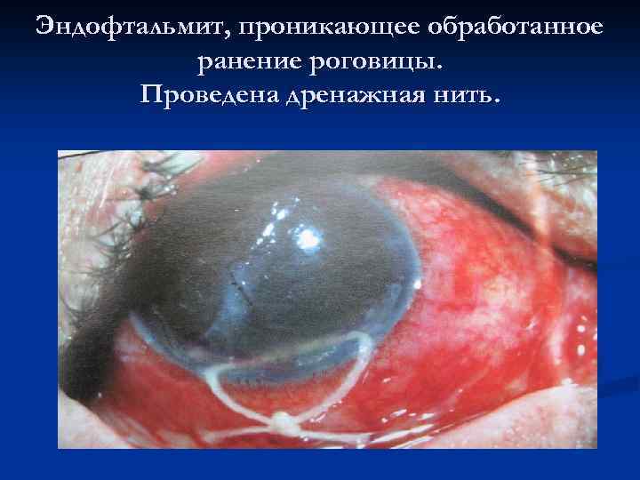 Эндофтальмит, проникающее обработанное ранение роговицы. Проведена дренажная нить. 