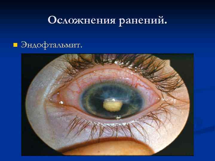 Осложнения ранений. n Эндофтальмит. 