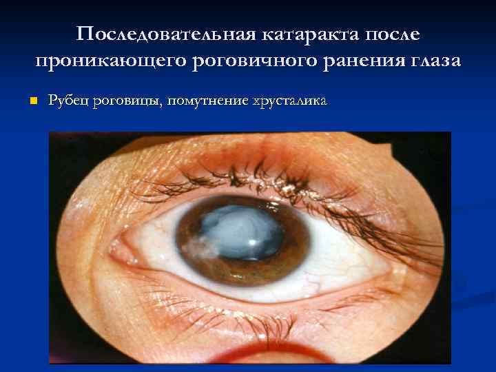 Последовательная катаракта после проникающего роговичного ранения глаза n Рубец роговицы, помутнение хрусталика 
