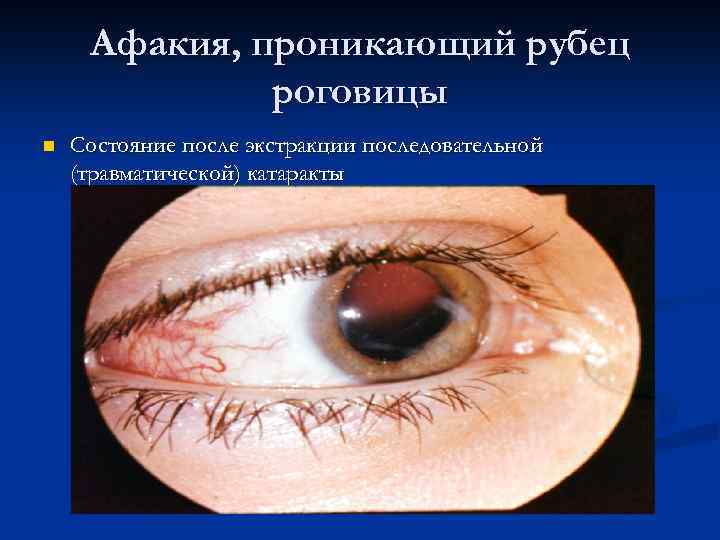 Афакия, проникающий рубец роговицы n Состояние после экстракции последовательной (травматической) катаракты 