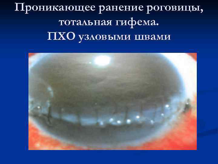 Проникающее ранение роговицы, тотальная гифема. ПХО узловыми швами 
