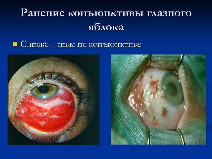 Ранение конъюнктивы глазного яблока n Справа – швы на конъюнктиве 
