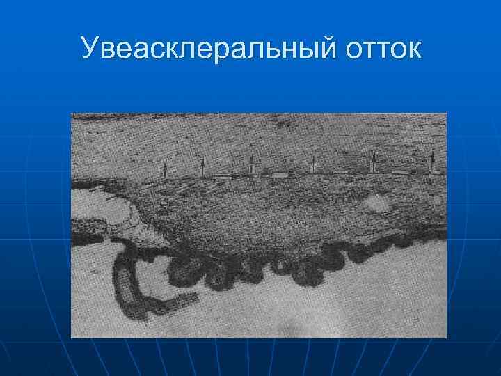 Увеасклеральный отток 