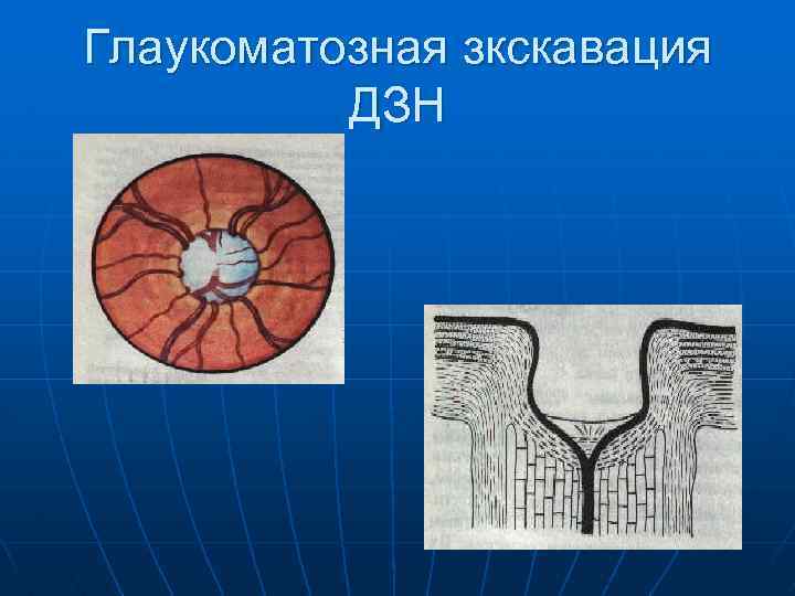 Окт ДЗН. Схема оттока внутриглазной жидкости.