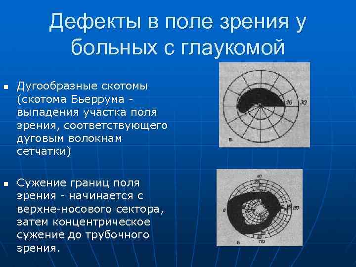 Дефекты в поле зрения у больных с глаукомой n n Дугообразные скотомы (скотома Бьеррума