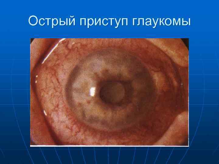 Острый приступ глаукомы 