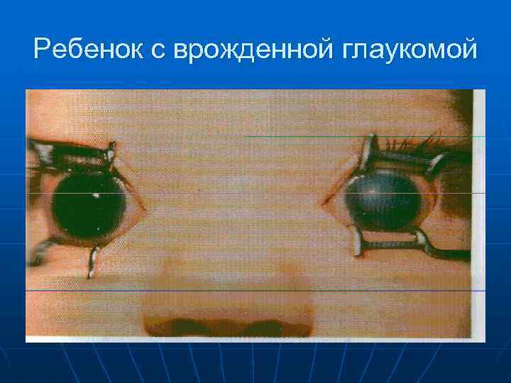 Ребенок с врожденной глаукомой 