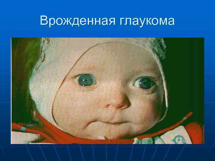 Врожденная глаукома 