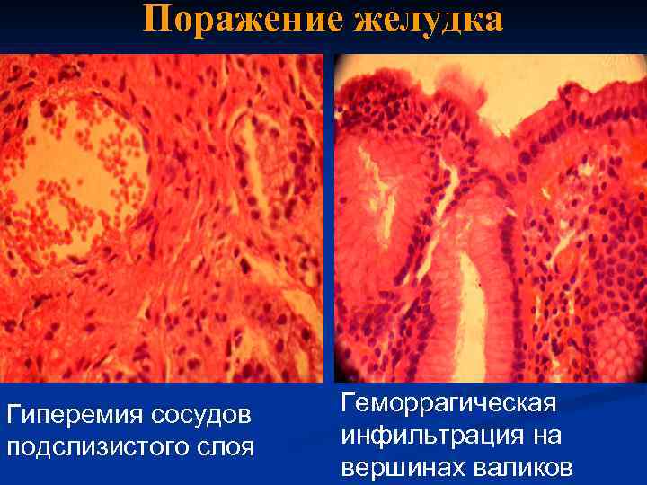 Поражение желудка Гиперемия сосудов подслизистого слоя Геморрагическая инфильтрация на вершинах валиков 