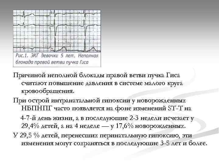 Неполная правой ножки гиса