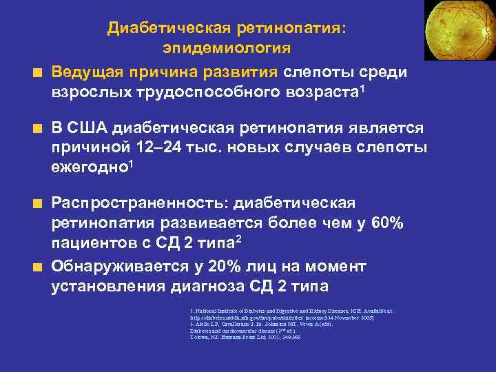 Диабетическая ретинопатия: эпидемиология Ведущая причина развития слепоты среди взрослых трудоспособного возраста 1 В США