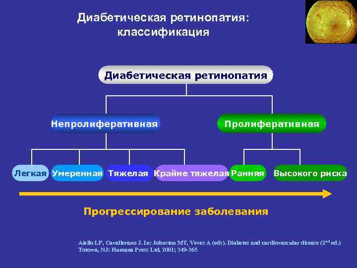 Диабетическая ретинопатия: классификация Диабетическая ретинопатия Непролиферативная Пролиферативная Легкая Умеренная Тяжелая Крайне тяжелая Ранняя Высокого