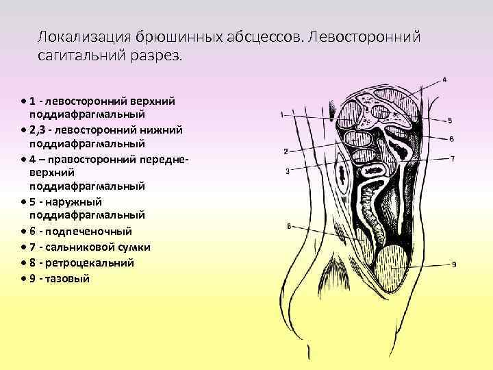 Метод забрюшинного дренирования абсцесса в правом передне верхнем пространстве · 1 - абсцесс ·