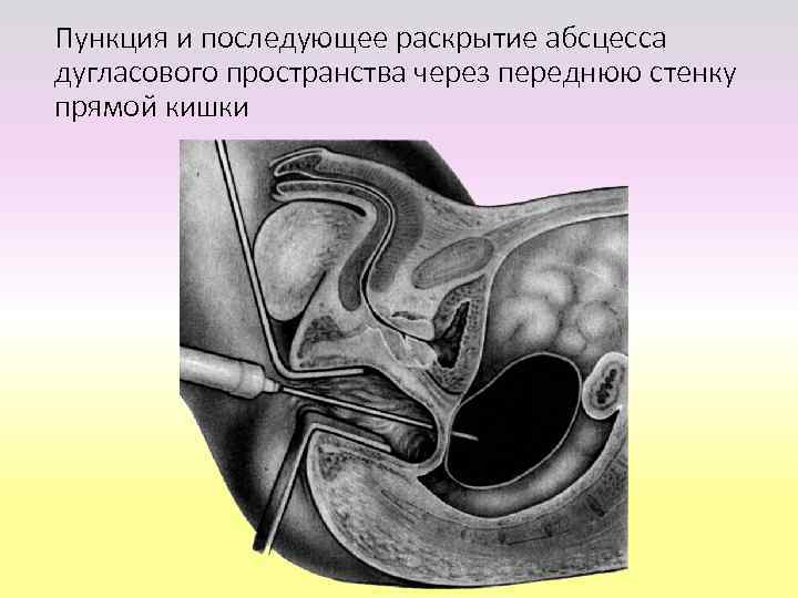 Раскрытие абсцесса через прямую кишку 