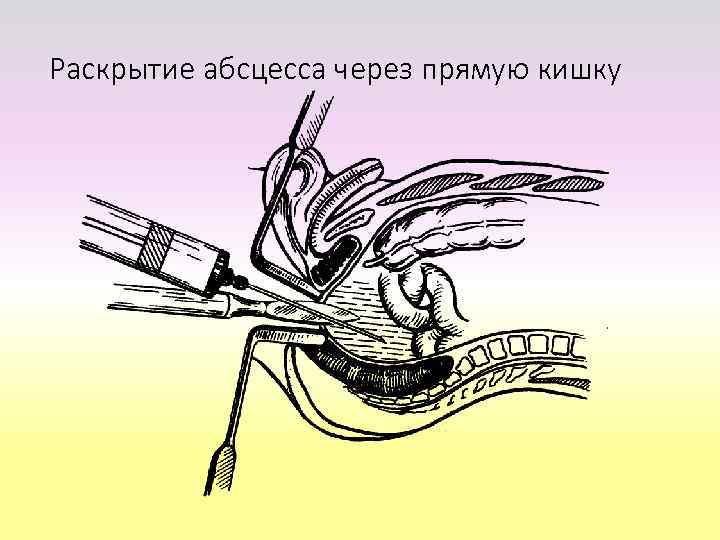 Дренирование абсцесса через разрез в стенке кишки 