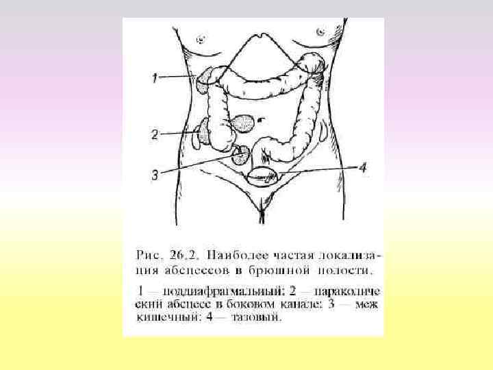  • Причиной абсцесса брюшной полости могут выступать гнойные  воспаления женских гениталий –