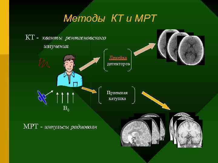 Методы КТ и МРТ КТ - кванты рентгеновского излучения Линейка детекторов Приемная катушка В